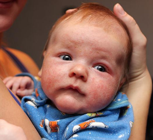 advice_eczema_slider_22a92949-28ac-4fc7-afe6-17b336d45f3e - Mustela Australia - 1