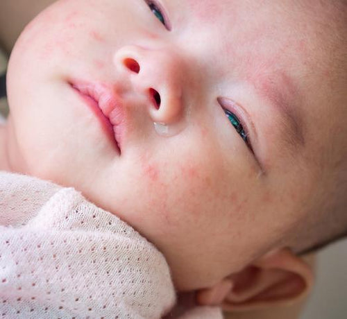 How can you improve your baby's sleep during eczema flare-ups? - Mustela Australia - 1