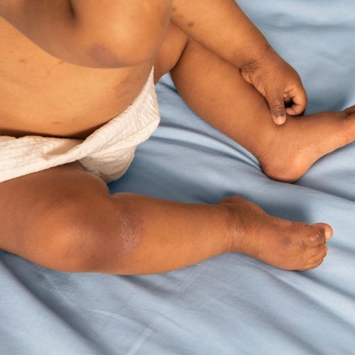 toddler legs with dry patches - Mustela Australia - 1