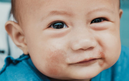 baby-with-eczema-on-his-face - Mustela Australia - 1