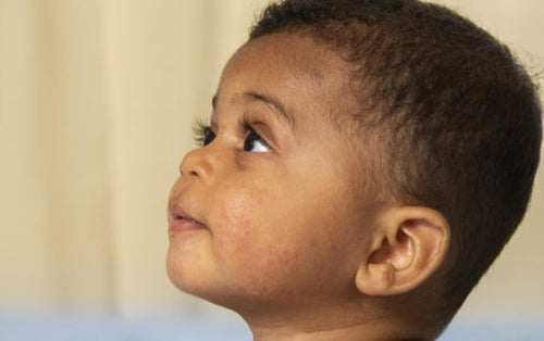 baby-face-with-eczema - Mustela Australia - 1