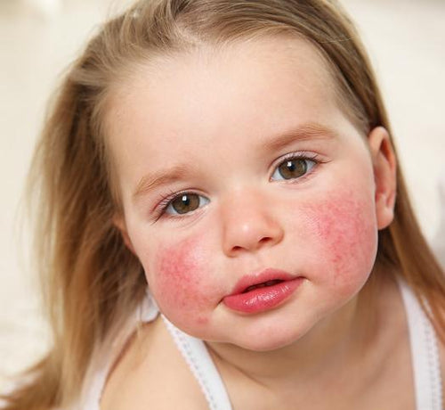 Eczema in Babies and Children: Glossary and Parents' FAQ - Mustela Australia - 1
