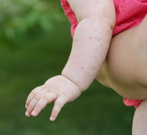 7 Types of Eczema: Symptoms, Causes and Care for the Whole Family - Mustela Australia - 1
