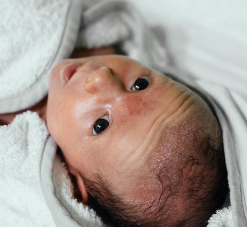 Dry Scalp Or Cradle Cap: What's The Difference? - Mustela Australia - 1