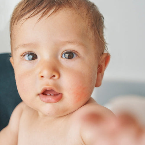 Close-up of a baby with light brown hair and big brown eyes looking at the camera, with visible redness and irritation on the cheeks. - Mustela Australia - 1
