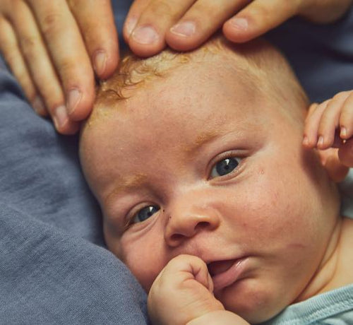 Cradle Cap On Your Baby's Face: Causes And Treatment - Mustela Australia - 1