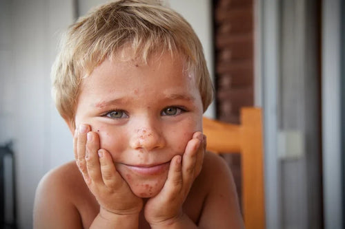 Will My Child Grow Out of Eczema? How Eczema Changes with Age - Mustela Australia - 1