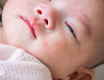 flare up baby eczema