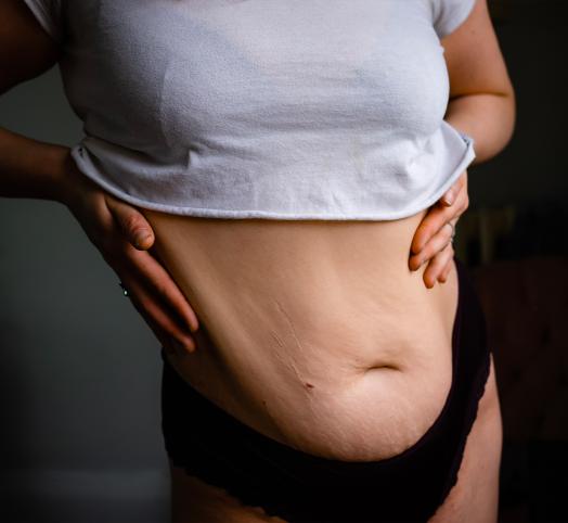 woman-postpartum-belly